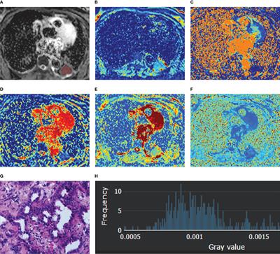 Whole-lesion histogram analysis of multiple diffusion metrics for differentiating lung cancer from inflammatory lesions